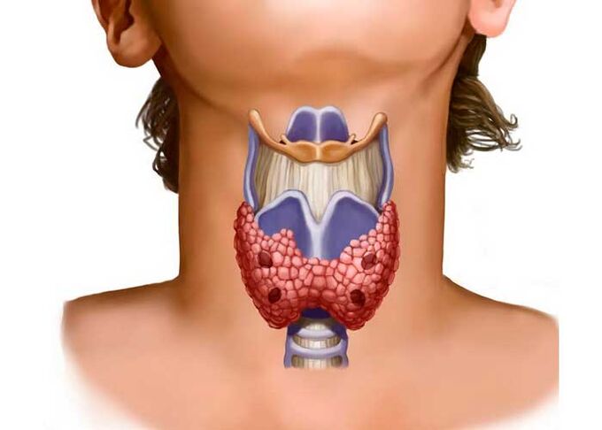 thyroid problems as the cause of neck pain