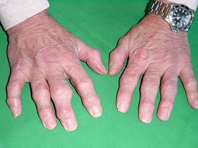 arthrosis of the fingers
