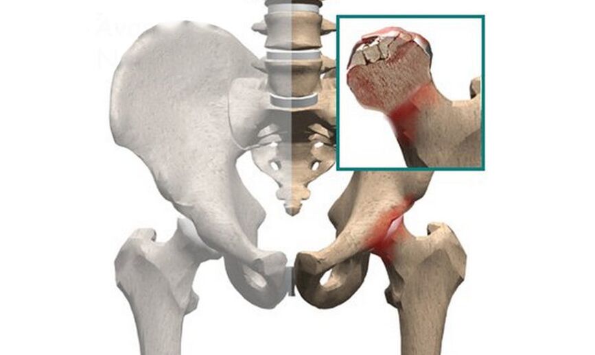 Femoral head necrosis is one of the causes of pain in the hip joint