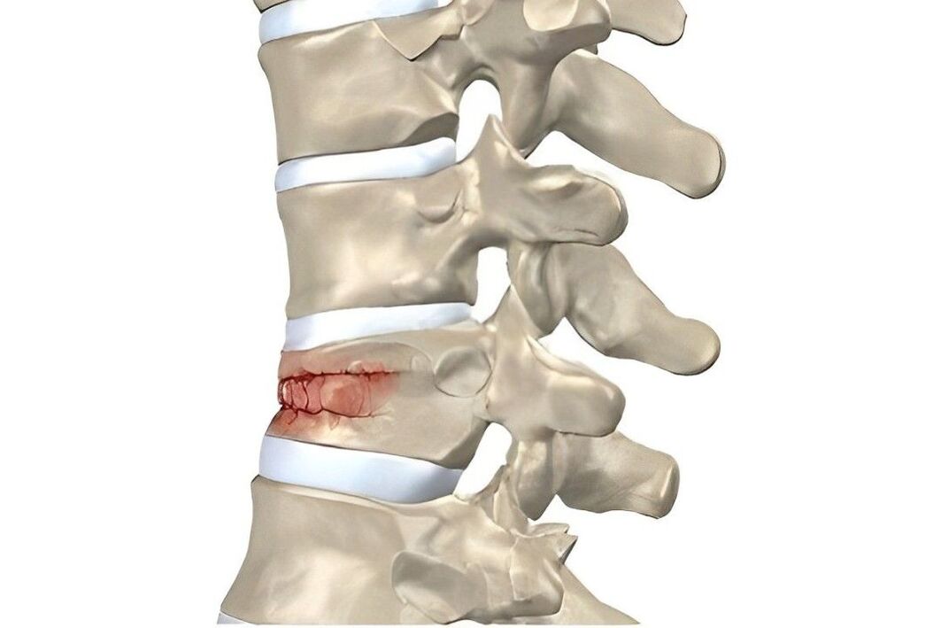 degree of spinal cord injury