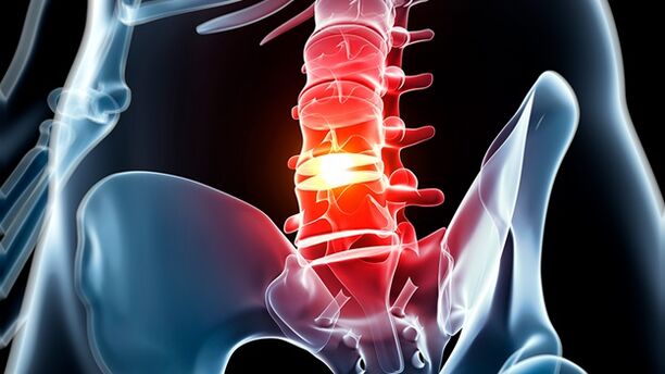 Osteocondrosis of the lomber spine