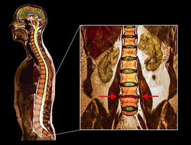 The degenerative disk in the waist