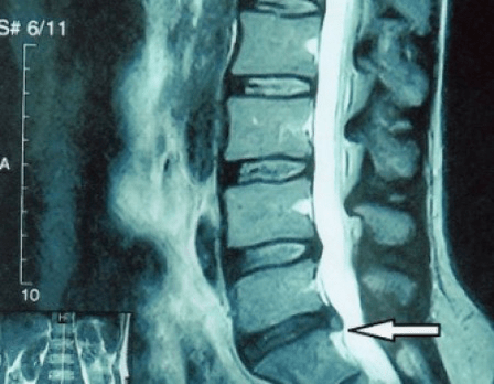 Spinal disc herniation on MRI scan