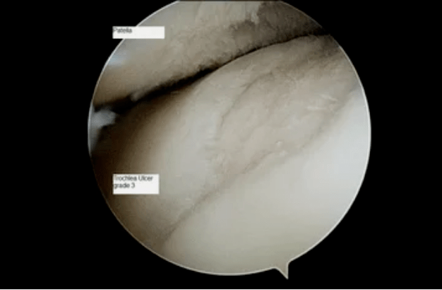 Astroscopic view of the knee joint with grade 3 arthrosis