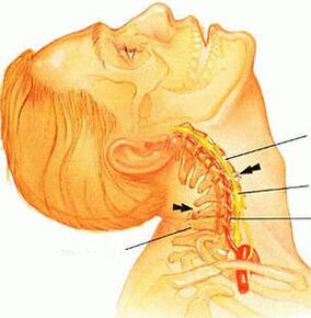 Osteochondrosis of the cervical spine